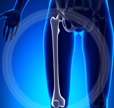 Qual è l’efficace fisioterapia per frattura al femore?